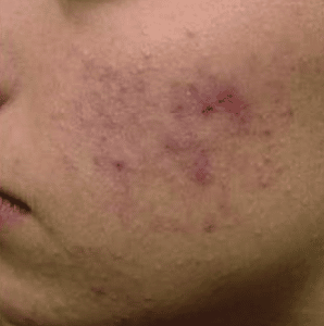 questions on pigment scars