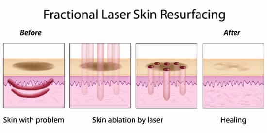 fractional laser skin resurfacing treatment singapore