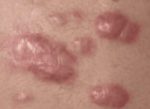 proven acne scar removal treatment-1