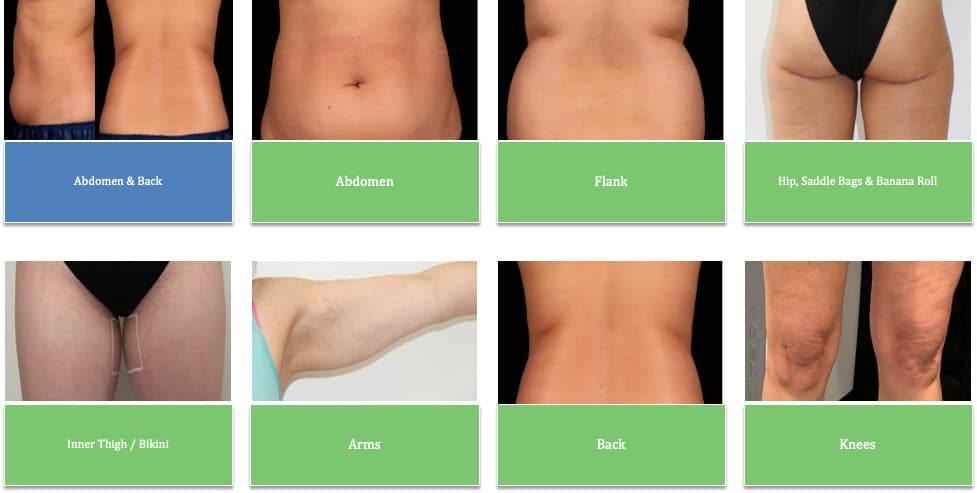 how to choose the best non invasive fat reduction treatment
