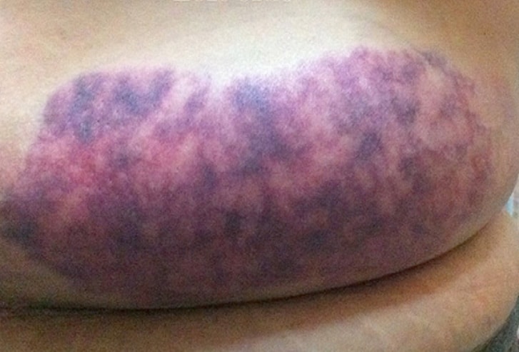 common bruising after coolsculpting