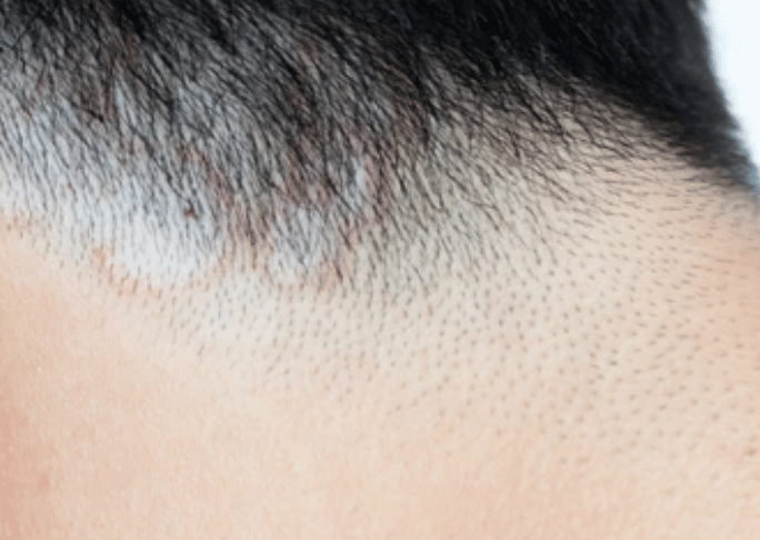hair loss fungal scalp infection