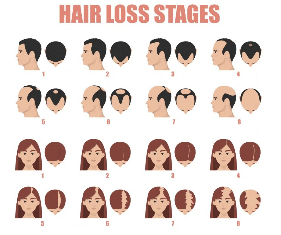Male Female Pattern Hair Loss